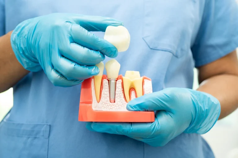 Implantes dentales en clínica en Málaga