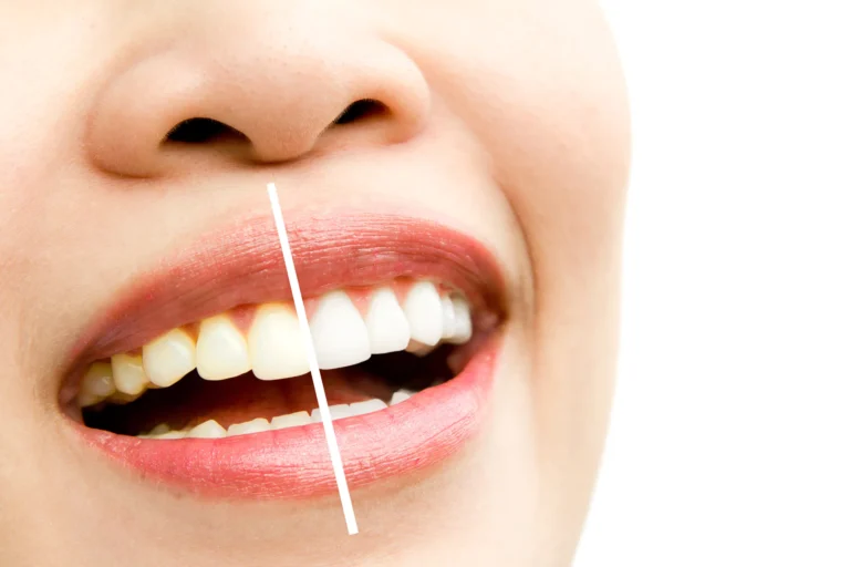 Tratamiento de estética y blanqueamiento dental en Málaga