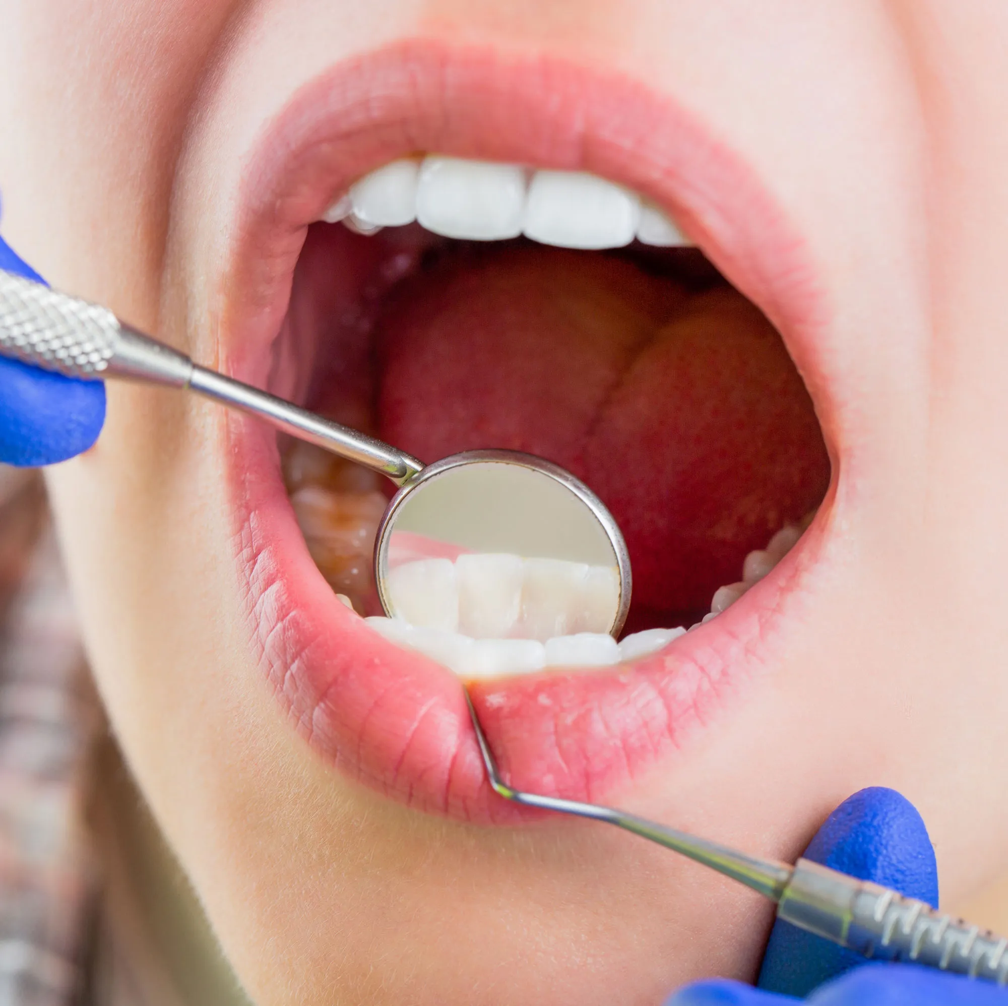 periodoncia en clinica dental Málaga